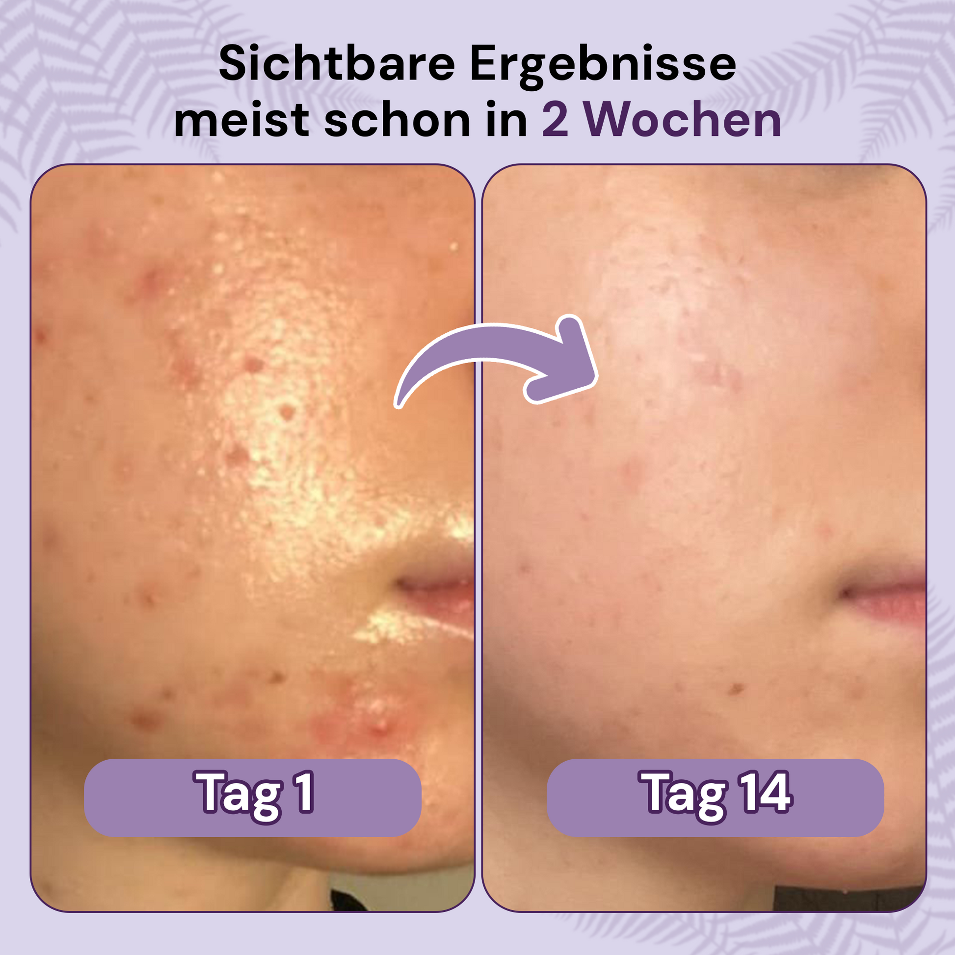 clese P1 - Bei Akne - cleseBIOSCIENCE