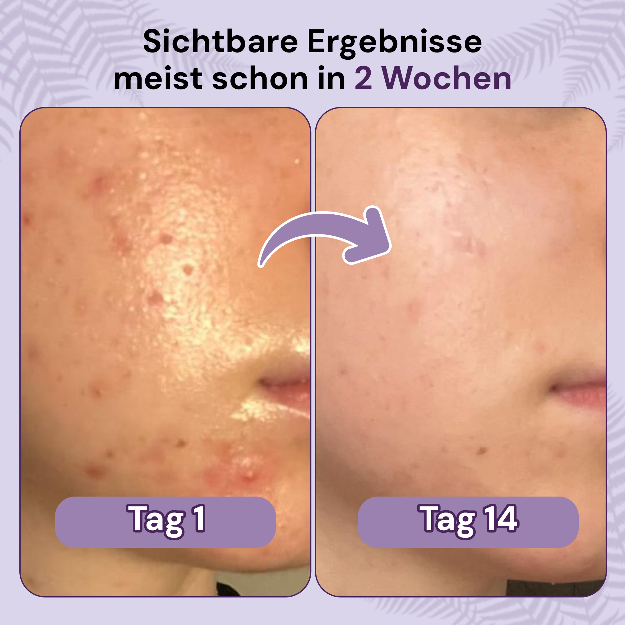 clese P1 - Bei Akne - cleseBIOSCIENCE