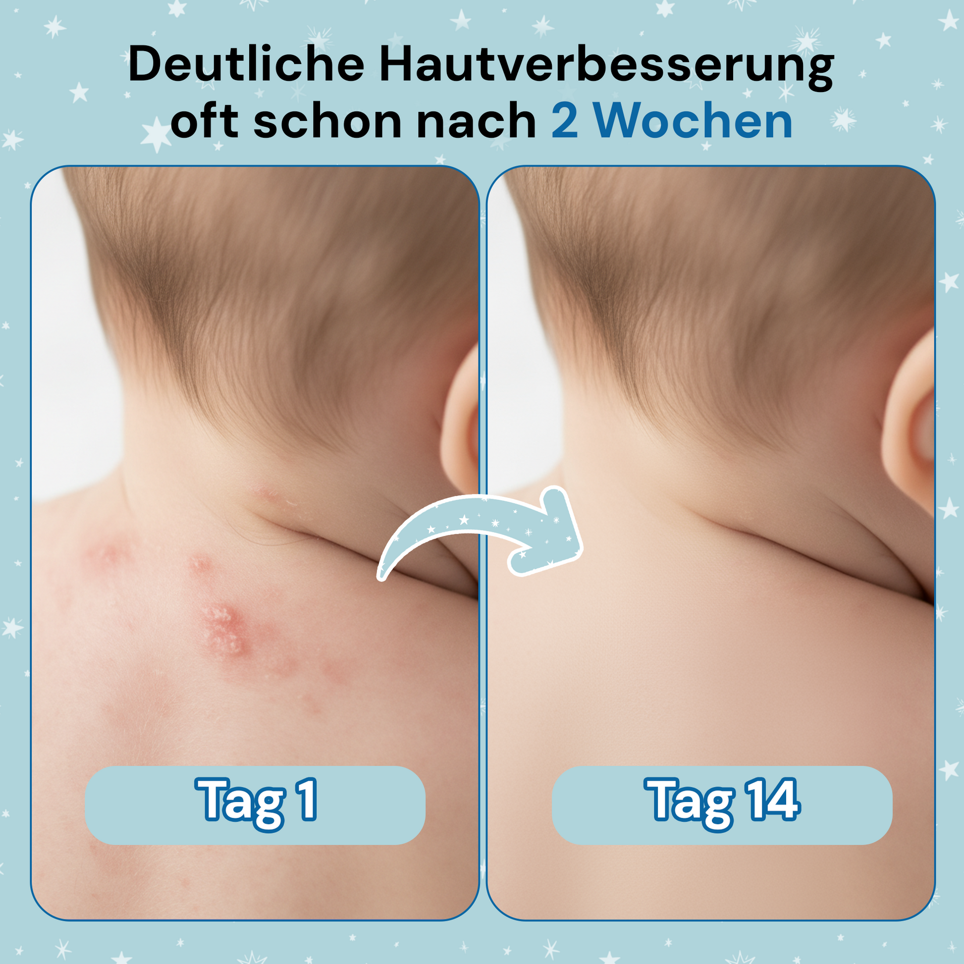 clese P4 - Für Babys & Kleinkinder mit Neurodermitis - cleseBIOSCIENCE