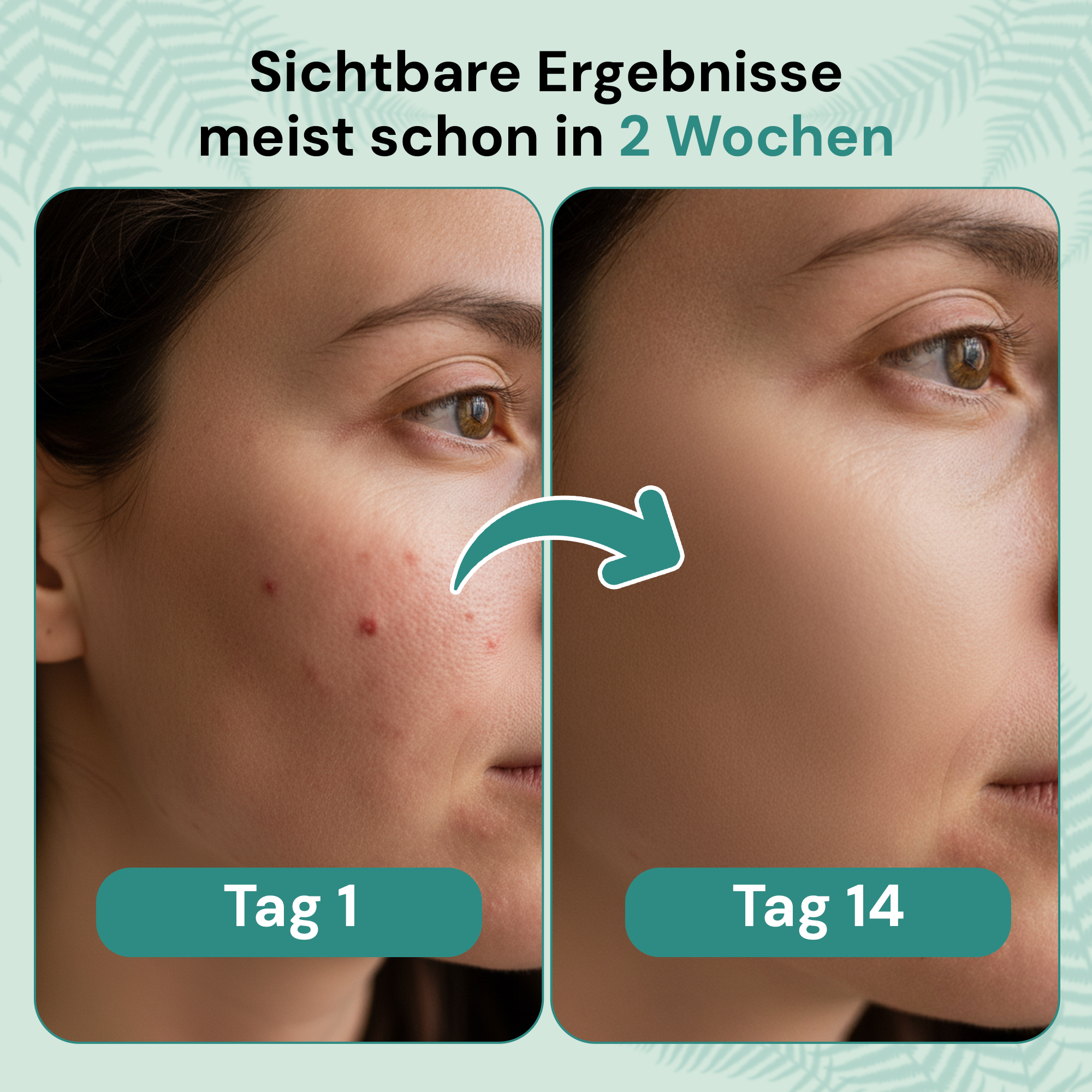 clese P3 - Bei Neurodermitis - cleseBIOSCIENCE