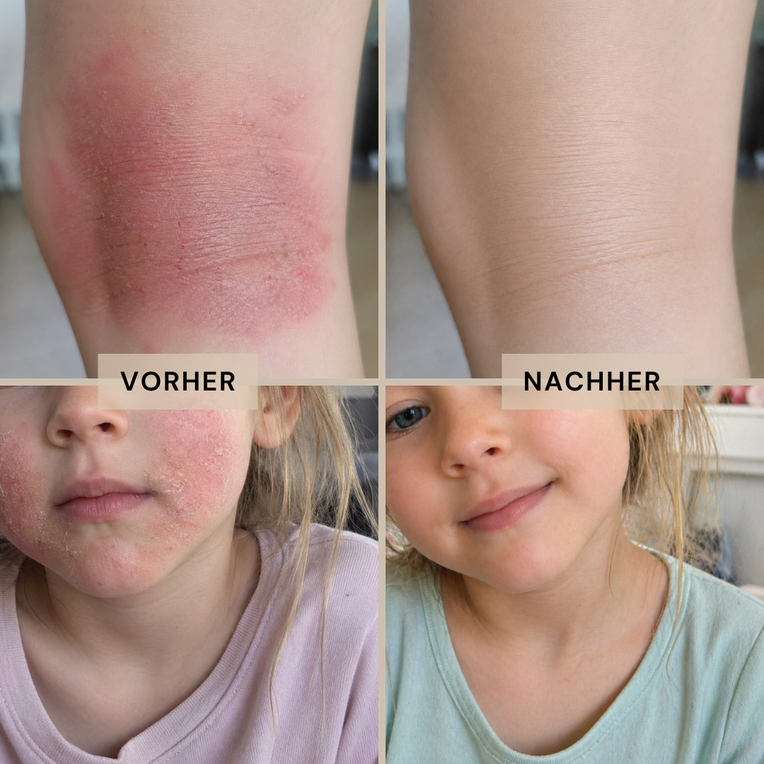 clese P4 - Für Babys & Kleinkinder mit Neurodermitis - cleseBIOSCIENCE