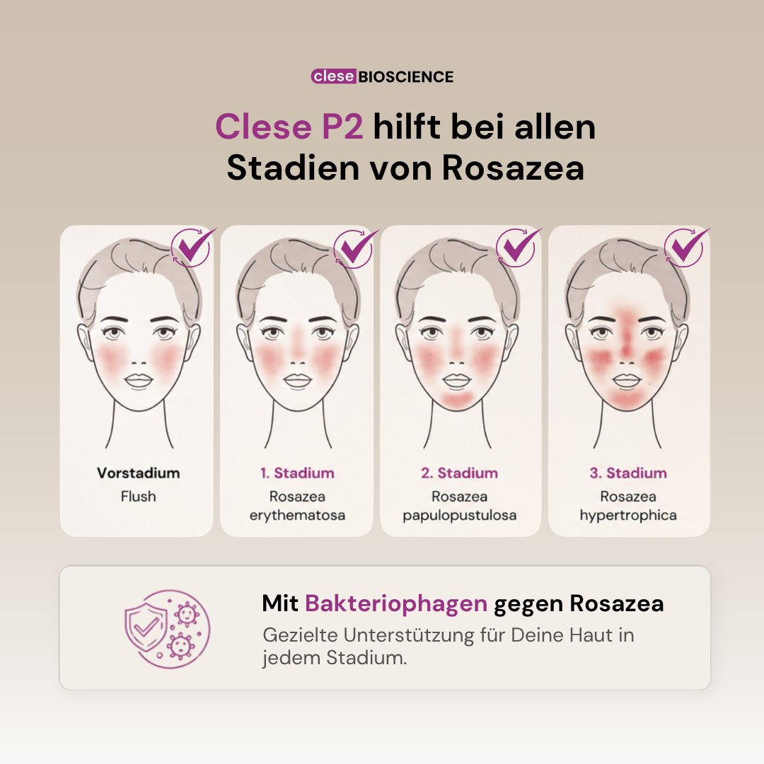 clese P2 - Bei Rosazea